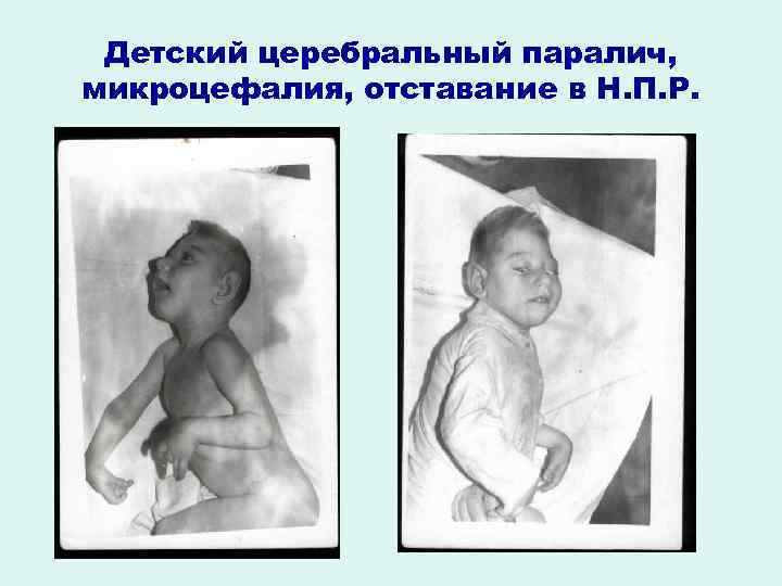 Детский церебральный паралич, микроцефалия, отставание в Н. П. Р. 