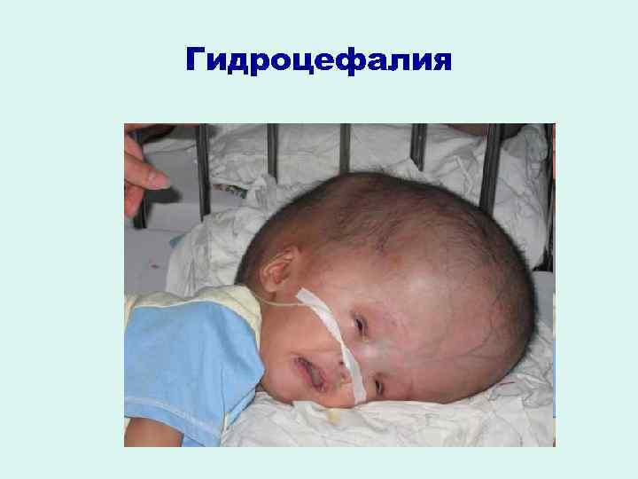 Гидроцефалия 