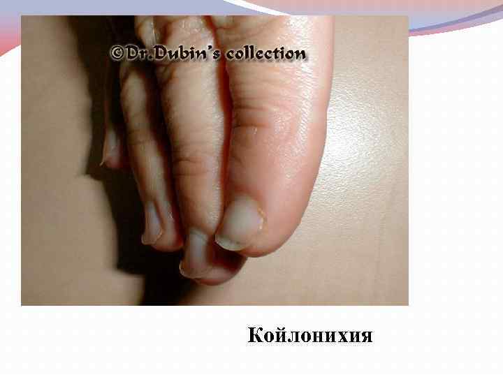 Койлонихия 