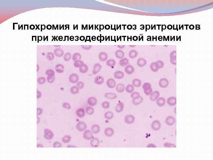 Гипохромия и микроцитоз эритроцитов при железодефицитной анемии 
