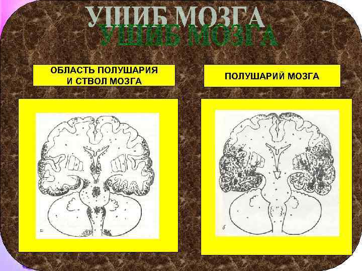 ОБЛАСТЬ ПОЛУШАРИЯ И СТВОЛ МОЗГА ПОЛУШАРИЙ МОЗГА 