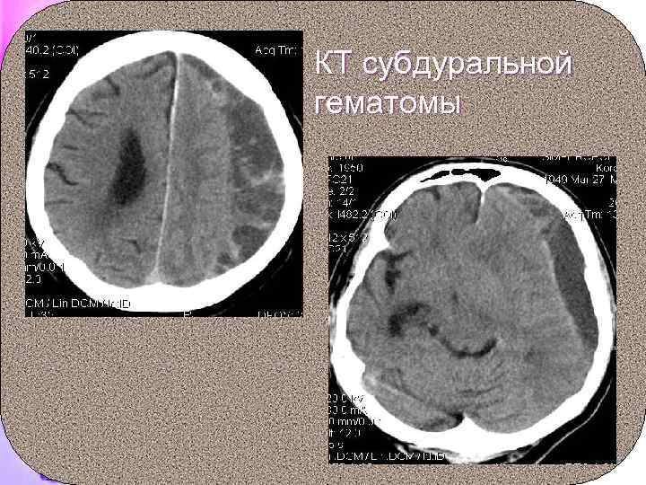 КТ субдуральной гематомы 