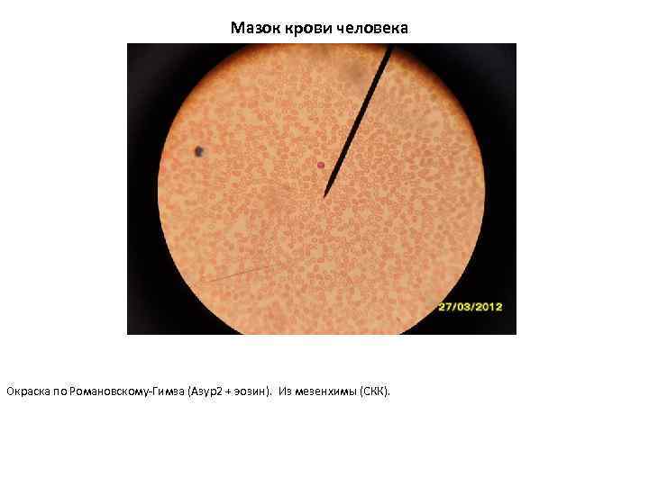 Мазок крови человека Окраска по Романовскому-Гимза (Азур2 + эозин). Из мезенхимы (СКК). 