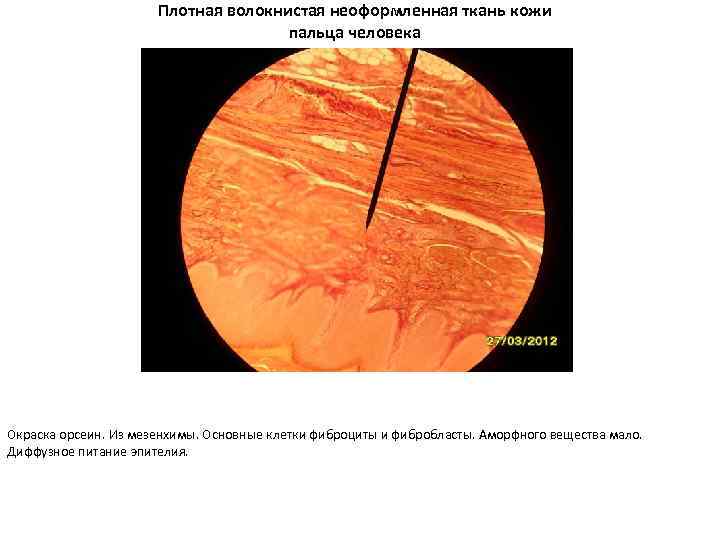 Плотная волокнистая неоформленная ткань кожи пальца человека Окраска орсеин. Из мезенхимы. Основные клетки фиброциты