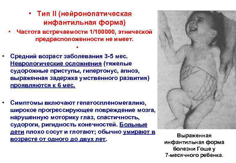  • Тип II (нейронопатическая инфантильная форма) • Частота встречаемости 1/100000, этнической предрасположенности не