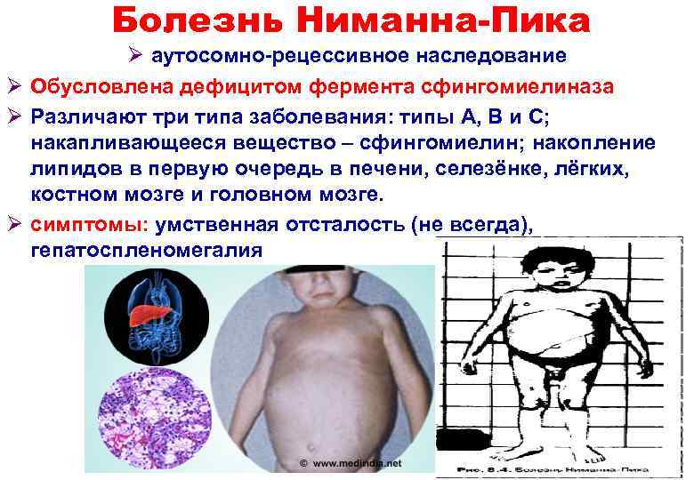 Болезнь Ниманна-Пика Ø аутосомно-рецессивное наследование Ø Обусловлена дефицитом фермента сфингомиелиназа Ø Различают три типа