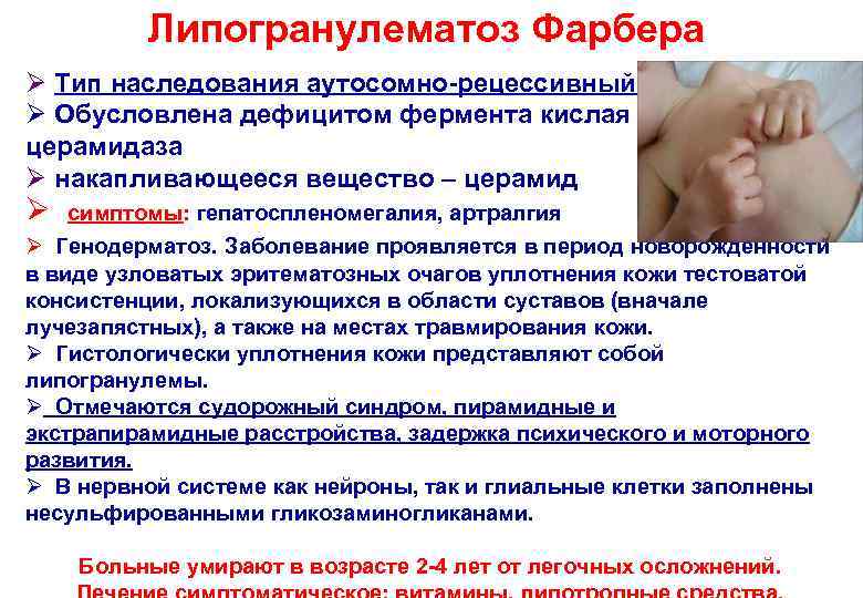 Липогранулематоз Фарбера Ø Тип наследования аутосомно-рецессивный Ø Обусловлена дефицитом фермента кислая церамидаза Ø накапливающееся