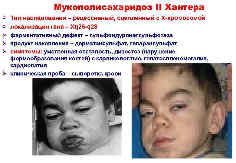 Мукополисахаридоз II Хантера Ø Ø Ø Тип наследования – рецессивный, сцепленный с Х-хромосомой локализация