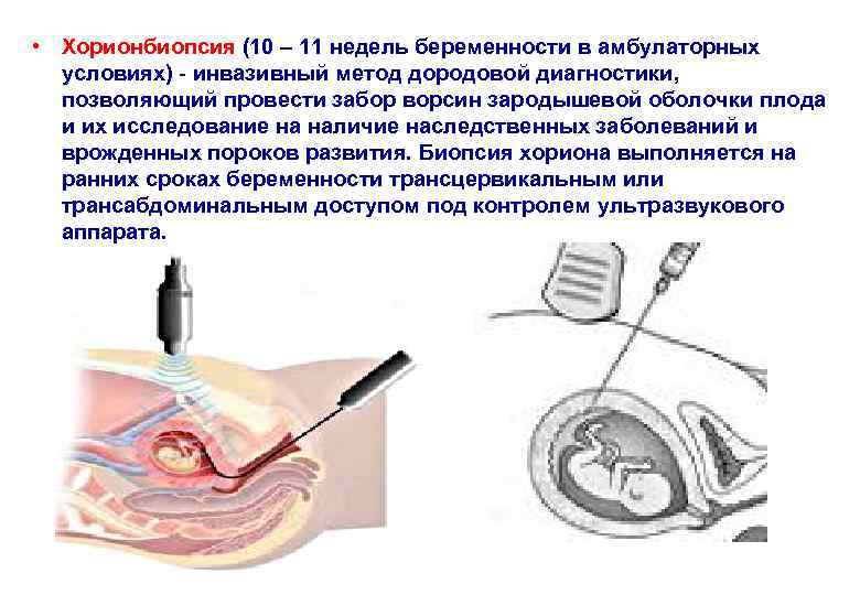  • Хорионбиопсия (10 – 11 недель беременности в амбулаторных условиях) - инвазивный метод