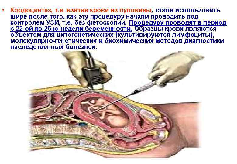  • Кордоцентез, т. е. взятия крови из пуповины, стали использовать шире после того,