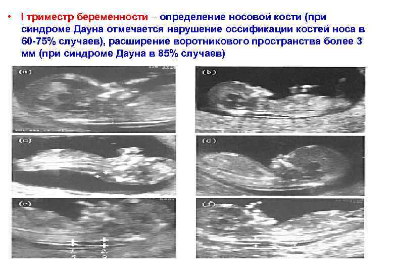  • I триместр беременности – определение носовой кости (при синдроме Дауна отмечается нарушение