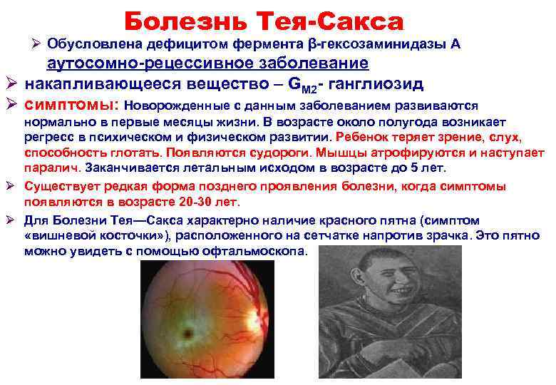 Болезнь Тея-Сакса Ø Обусловлена дефицитом фермента β-гексозаминидазы А аутосомно-рецессивное заболевание Ø накапливающееся вещество –