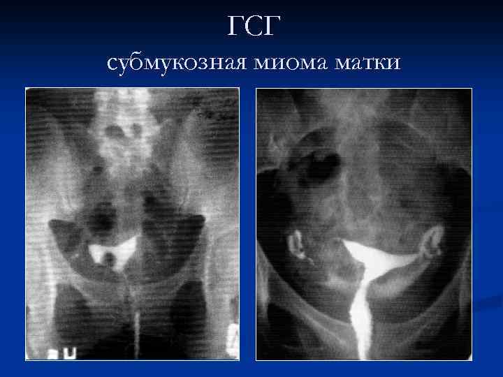 ГСГ субмукозная миома матки 