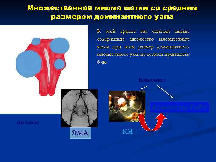 Множественная миома матки со средним размером доминантного узла К этой группе мы отнесли матки,