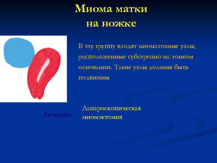 Миома матки на ножке В эту группу входят миоматозные узлы, расположенные субсерозно на тонком