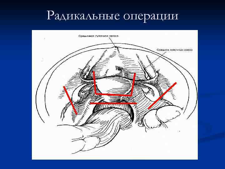 Радикальные операции 