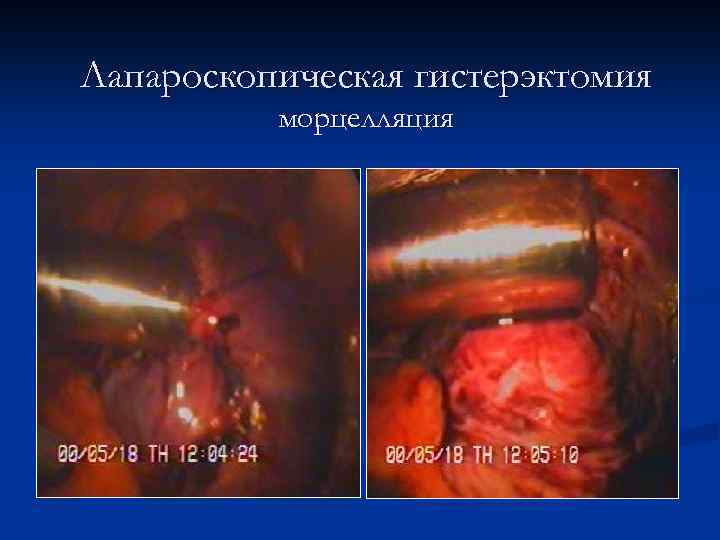 Лапароскопическая гистерэктомия морцелляция 