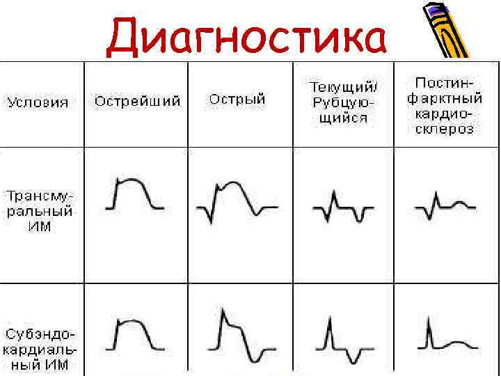 Диагностика ЭКГ по периодам 