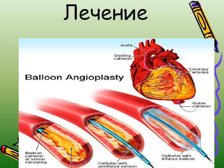 Лечение восстановления коронарного кровотока 