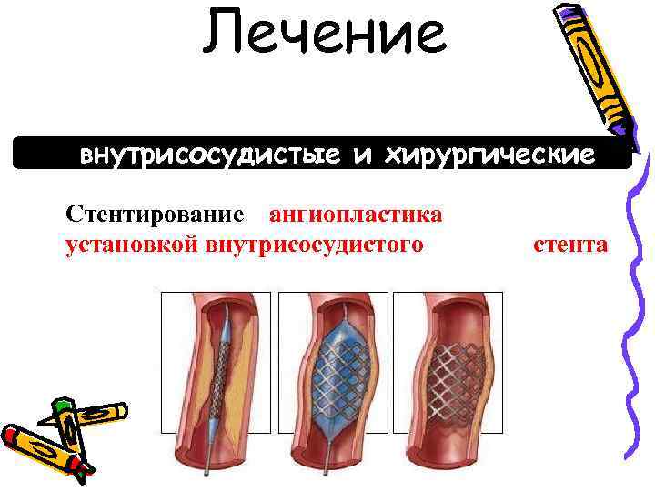 Лечение внутрисосудистые и хирургические восстановления методы кровотока коронарного Стентирование – ангиопластика с последующей установкой