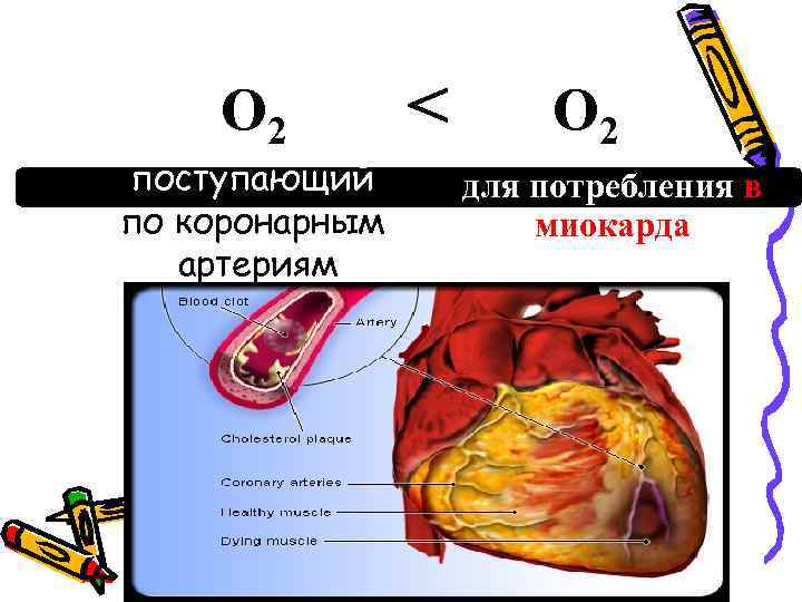 О 2 поступающий по коронарным артериям < О 2 для потребления в миокарда 