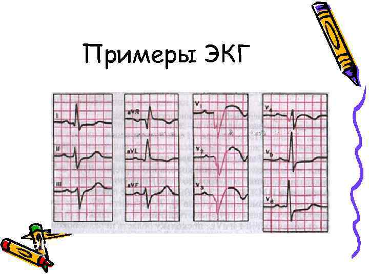 Примеры ЭКГ при переднеперегородочном и верхушечном инфаркте миокарда 