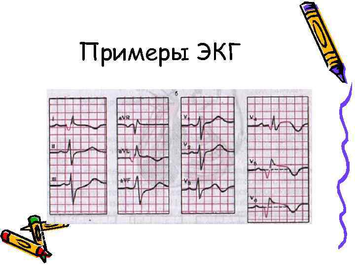 Примеры ЭКГ при переднебоковом инфаркте миокарда 