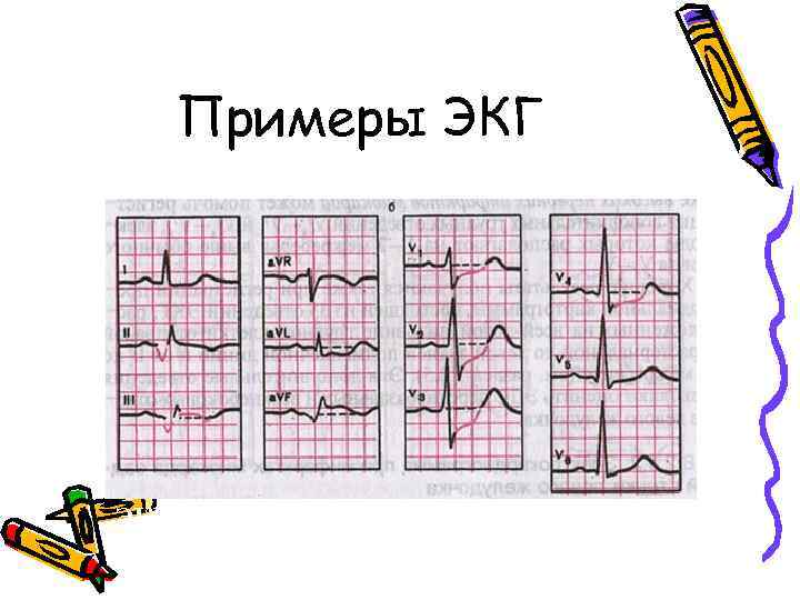 Примеры ЭКГ при заднедиафрагмальном инфаркте миокарда 