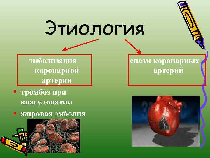 Этиология эмболизация коронарной артерии § тромбоз при коагулопатии § жировая эмболия спазм коронарных артерий