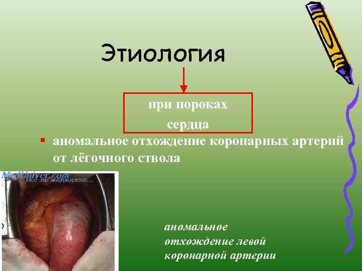 Этиология при пороках сердца § аномальное отхождение коронарных артерий от лёгочного ствола аномальное отхождение