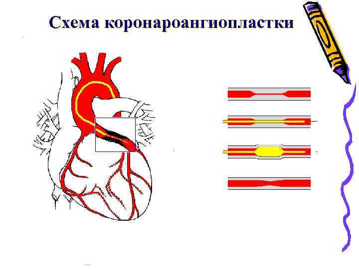 Схема коронароангиопластки 