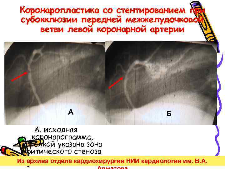 Коронаропластика со стентированием при субокклюзии передней межжелудочковой ветви левой коронарной артерии А А. исходная