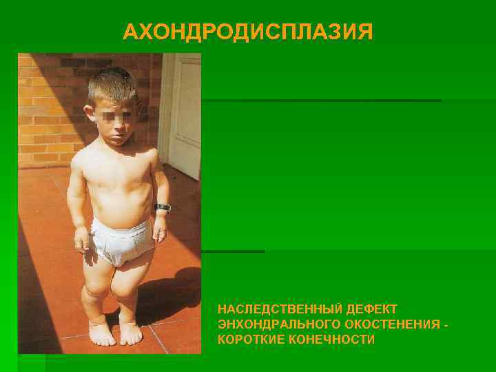 АХОНДРОДИСПЛАЗИЯ НАСЛЕДСТВЕННЫЙ ДЕФЕКТ ЭНХОНДРАЛЬНОГО ОКОСТЕНЕНИЯ КОРОТКИЕ КОНЕЧНОСТИ 