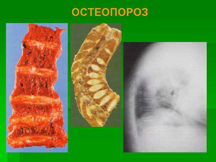 ОСТЕОПОРОЗ 