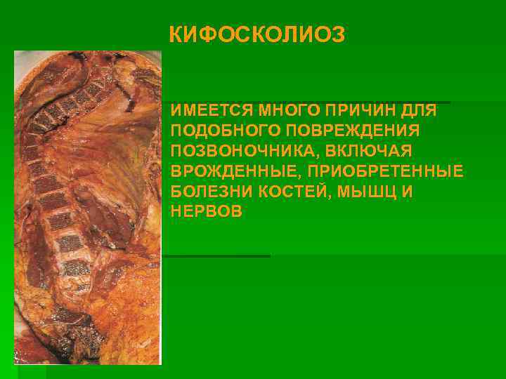 КИФОСКОЛИОЗ ИМЕЕТСЯ МНОГО ПРИЧИН ДЛЯ ПОДОБНОГО ПОВРЕЖДЕНИЯ ПОЗВОНОЧНИКА, ВКЛЮЧАЯ ВРОЖДЕННЫЕ, ПРИОБРЕТЕННЫЕ БОЛЕЗНИ КОСТЕЙ, МЫШЦ