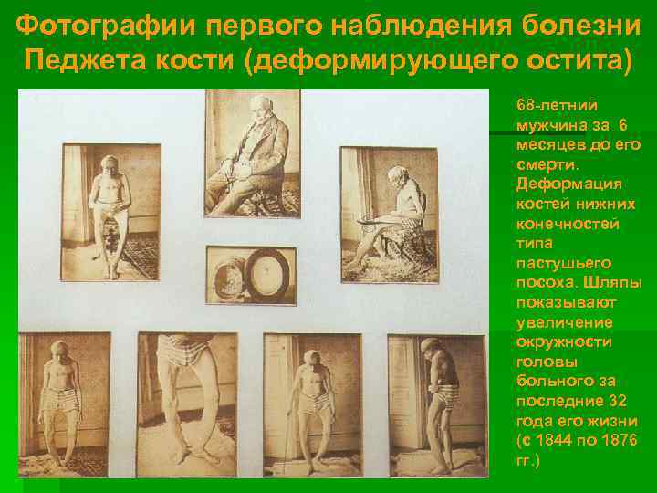 Фотографии первого наблюдения болезни Педжета кости (деформирующего остита) 68 -летний мужчина за 6 месяцев