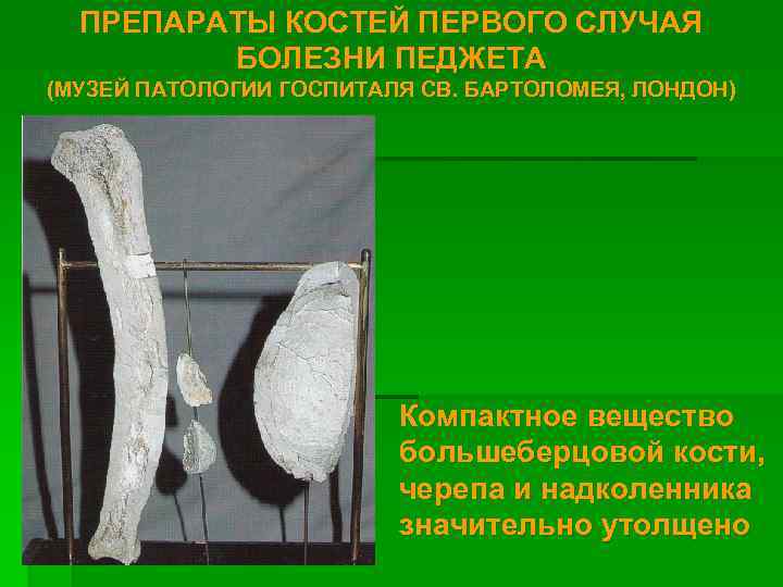 ПРЕПАРАТЫ КОСТЕЙ ПЕРВОГО СЛУЧАЯ БОЛЕЗНИ ПЕДЖЕТА (МУЗЕЙ ПАТОЛОГИИ ГОСПИТАЛЯ СВ. БАРТОЛОМЕЯ, ЛОНДОН) Компактное вещество