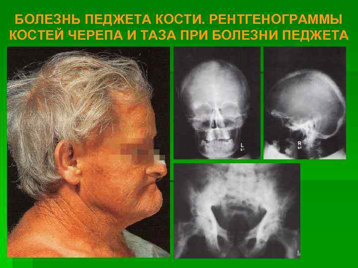 БОЛЕЗНЬ ПЕДЖЕТА КОСТИ. РЕНТГЕНОГРАММЫ КОСТЕЙ ЧЕРЕПА И ТАЗА ПРИ БОЛЕЗНИ ПЕДЖЕТА 