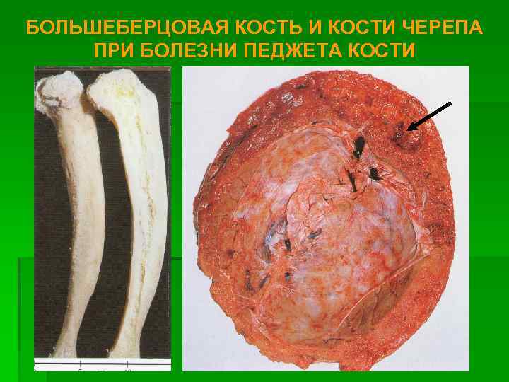 БОЛЬШЕБЕРЦОВАЯ КОСТЬ И КОСТИ ЧЕРЕПА ПРИ БОЛЕЗНИ ПЕДЖЕТА КОСТИ 