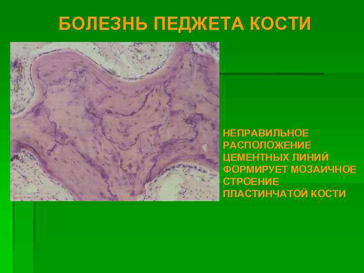 БОЛЕЗНЬ ПЕДЖЕТА КОСТИ НЕПРАВИЛЬНОЕ РАСПОЛОЖЕНИЕ ЦЕМЕНТНЫХ ЛИНИЙ ФОРМИРУЕТ МОЗАИЧНОЕ СТРОЕНИЕ ПЛАСТИНЧАТОЙ КОСТИ 