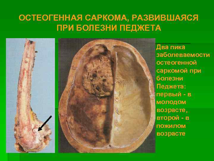 ОСТЕОГЕННАЯ САРКОМА, РАЗВИВШАЯСЯ ПРИ БОЛЕЗНИ ПЕДЖЕТА Два пика заболеваемости остеогенной саркомой при болезни Педжета: