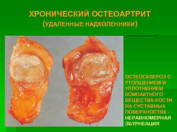 ХРОНИЧЕСКИЙ ОСТЕОАРТРИТ (УДАЛЕННЫЕ НАДКОЛЕННИКИ) ОСТЕОСКЛЕРОЗ С УТОЛЩЕНИЕМ И УПЛОТНЕНИЕМ КОМПАКТНОГО ВЕЩЕСТВА КОСТИ НА СУСТАВНЫХ
