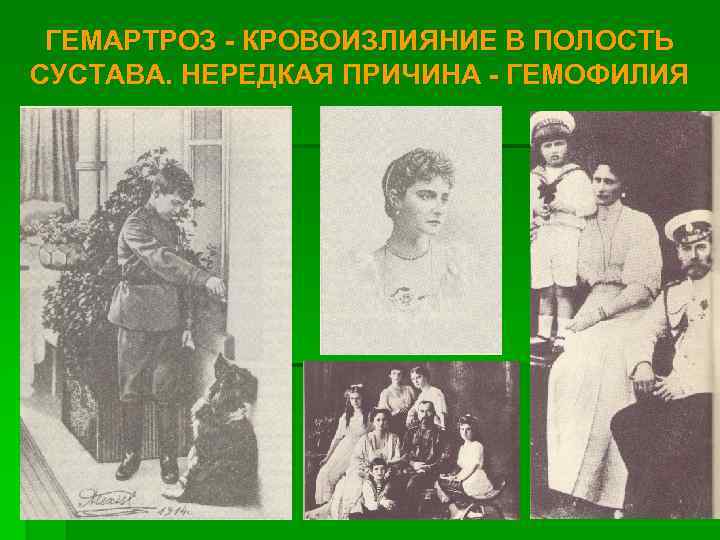 ГЕМАРТРОЗ - КРОВОИЗЛИЯНИЕ В ПОЛОСТЬ СУСТАВА. НЕРЕДКАЯ ПРИЧИНА - ГЕМОФИЛИЯ 