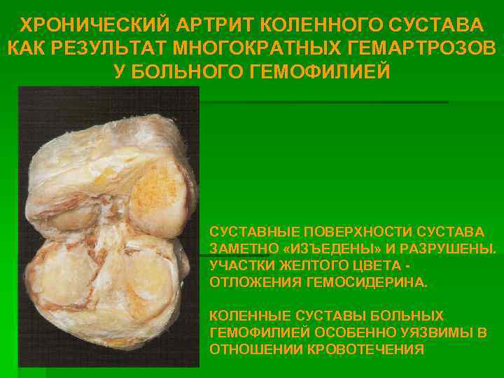 ХРОНИЧЕСКИЙ АРТРИТ КОЛЕННОГО СУСТАВА КАК РЕЗУЛЬТАТ МНОГОКРАТНЫХ ГЕМАРТРОЗОВ У БОЛЬНОГО ГЕМОФИЛИЕЙ СУСТАВНЫЕ ПОВЕРХНОСТИ СУСТАВА