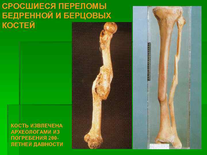СРОСШИЕСЯ ПЕРЕЛОМЫ БЕДРЕННОЙ И БЕРЦОВЫХ КОСТЕЙ КОСТЬ ИЗВЛЕЧЕНА АРХЕОЛОГАМИ ИЗ ПОГРЕБЕНИЯ 200 ЛЕТНЕЙ ДАВНОСТИ