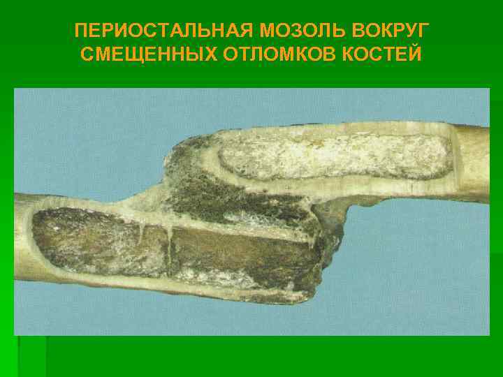 ПЕРИОСТАЛЬНАЯ МОЗОЛЬ ВОКРУГ СМЕЩЕННЫХ ОТЛОМКОВ КОСТЕЙ 