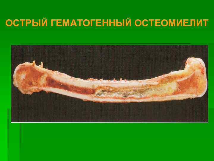 ОСТРЫЙ ГЕМАТОГЕННЫЙ ОСТЕОМИЕЛИТ 