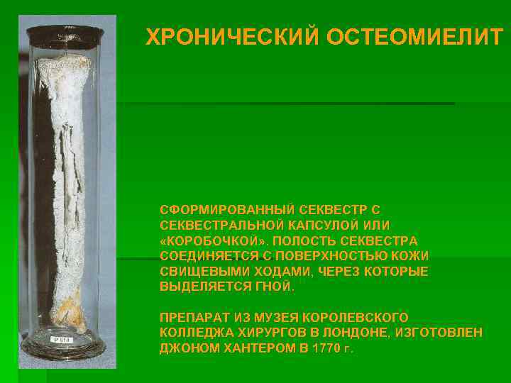 ХРОНИЧЕСКИЙ ОСТЕОМИЕЛИТ СФОРМИРОВАННЫЙ СЕКВЕСТР С СЕКВЕСТРАЛЬНОЙ КАПСУЛОЙ ИЛИ «КОРОБОЧКОЙ» . ПОЛОСТЬ СЕКВЕСТРА СОЕДИНЯЕТСЯ С