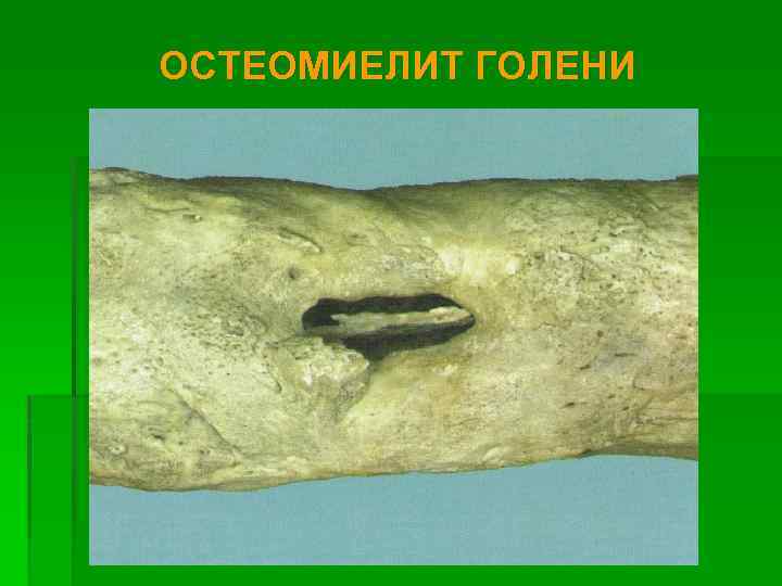 ОСТЕОМИЕЛИТ ГОЛЕНИ 