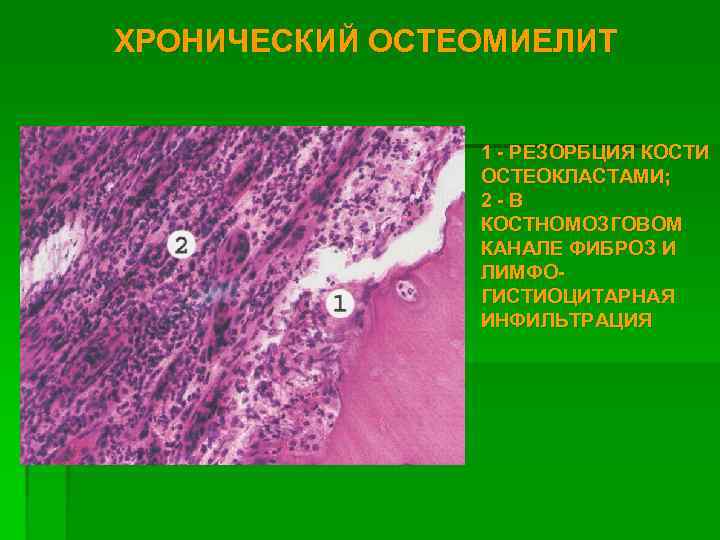 ХРОНИЧЕСКИЙ ОСТЕОМИЕЛИТ 1 - РЕЗОРБЦИЯ КОСТИ ОСТЕОКЛАСТАМИ; 2 -В КОСТНОМОЗГОВОМ КАНАЛЕ ФИБРОЗ И ЛИМФОГИСТИОЦИТАРНАЯ
